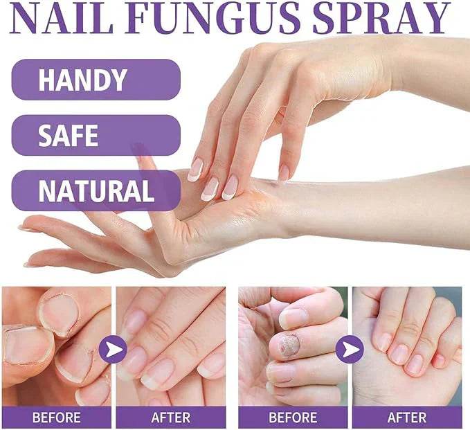nail fungus spray